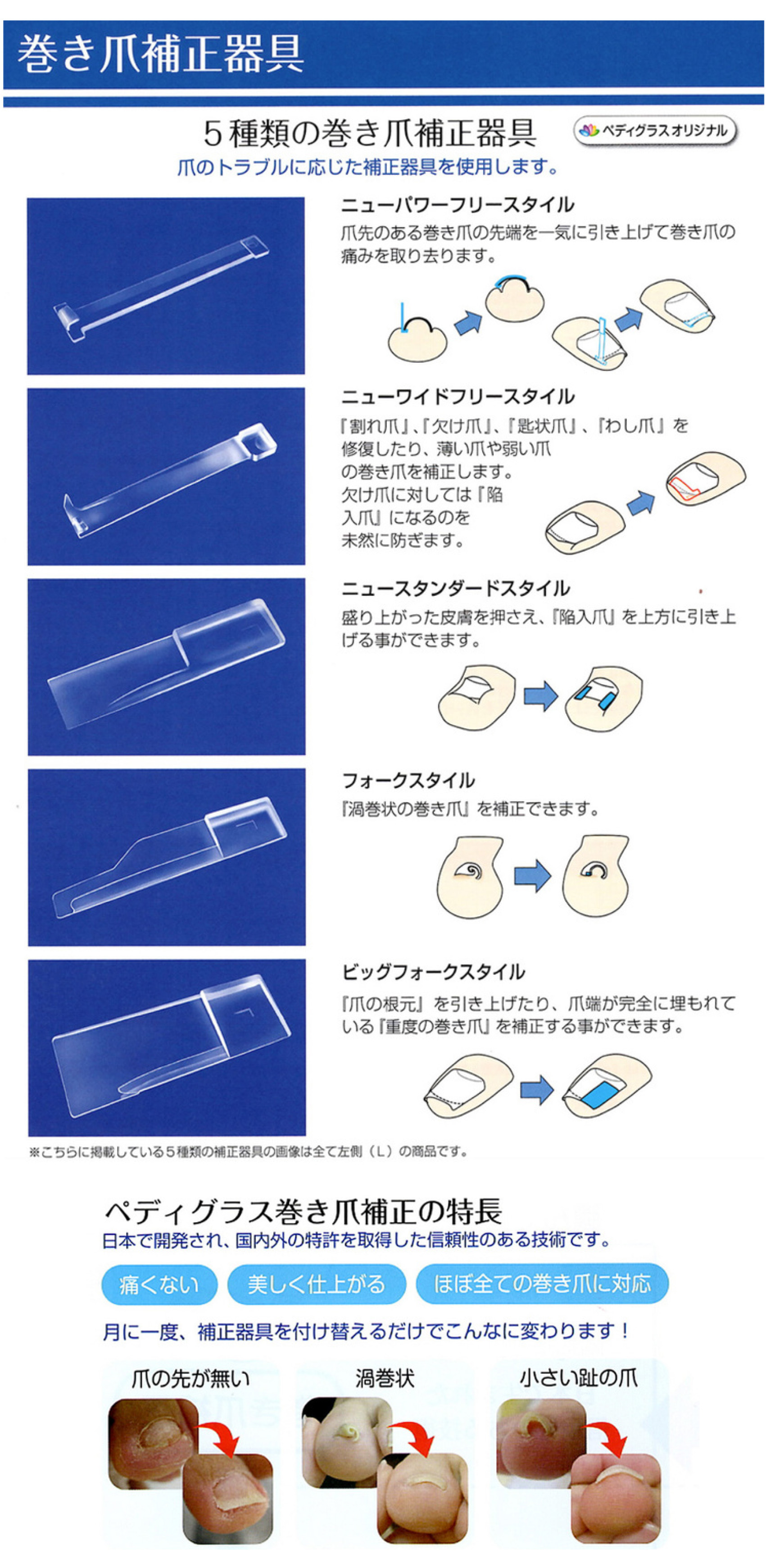 巻き爪